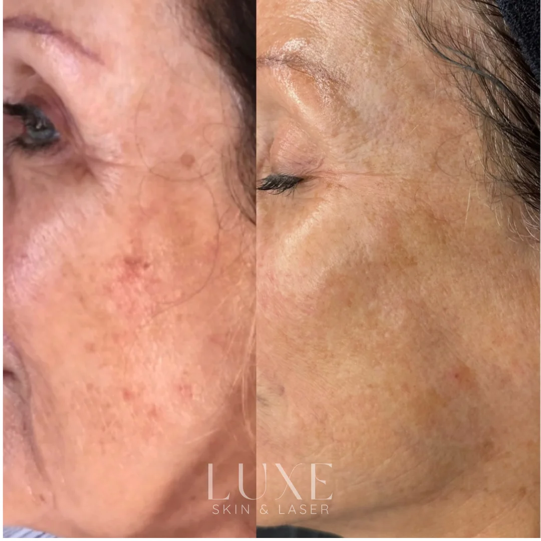 Luxe.zip-10 Hydrofacial before and after — Luxe Skin & Laser
