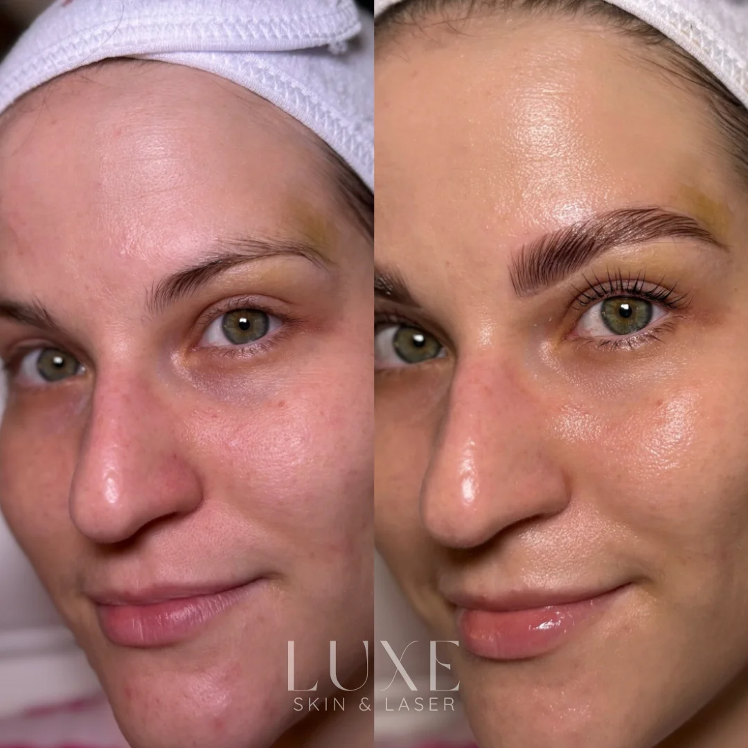 Luxe.zip-11 Hydrofacial results (before and after) — Luxe Skin & Laser