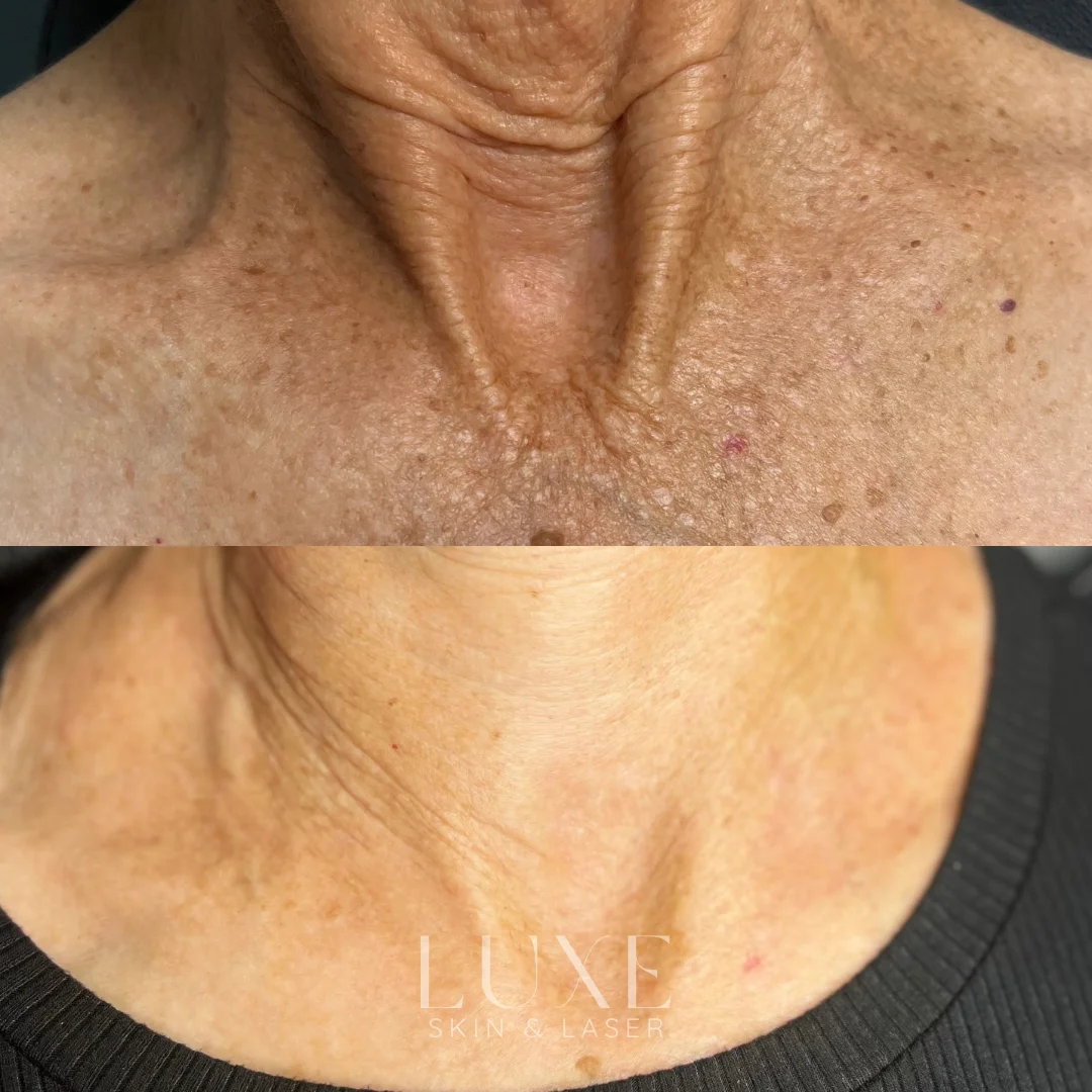 Luxe.zip-18 Neckline wrinkle treatment results (before and after) — Luxe Skin & Laser