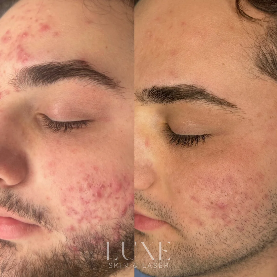 Luxe.zip-2 Acne treatment results (before and after) — Luxe Skin & Laser