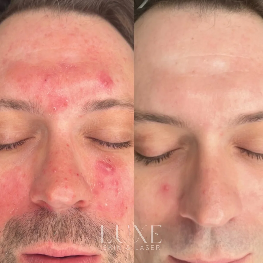 Luxe.zip-20 Acne treatment (before and after) — Luxe Skin & Laser