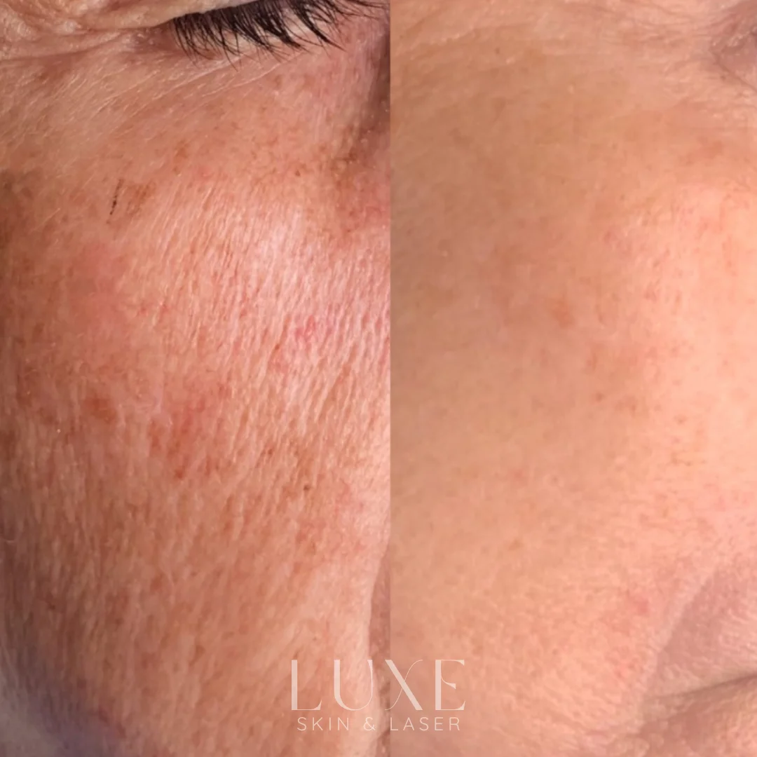 Luxe.zip-21 Age-spot reduction on face (before and after) — Luxe Skin & Laser
